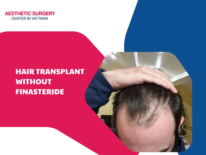 Hair transplant without Finasteride: Is it a problem? Other methods