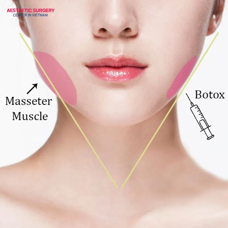 The effects of masseter botox last from 3 to 6 months.