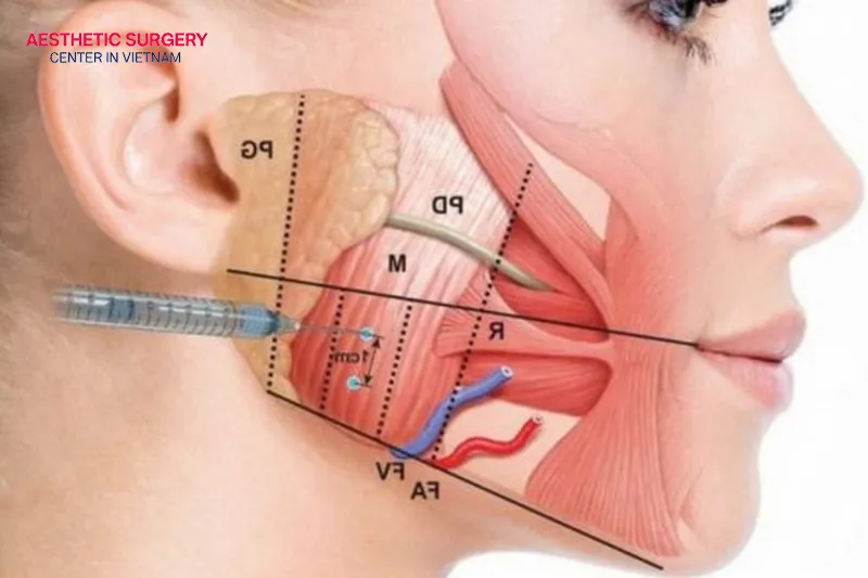 Teeth grinding can be managed with botox for 3 to 6 months.
