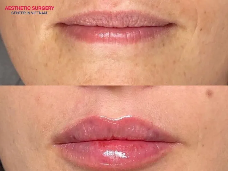 Depending on the current lip shape, the doctor will recommend the appropriate filler dosage and provide the total lip filler cost for the procedure.