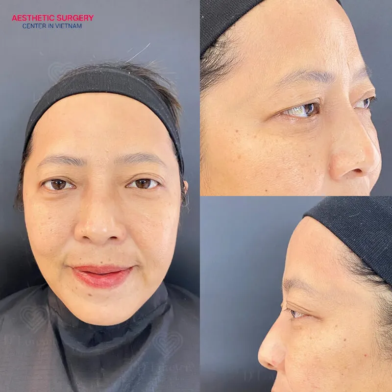 Many clients are satisfied with the results of under eye filler injections.