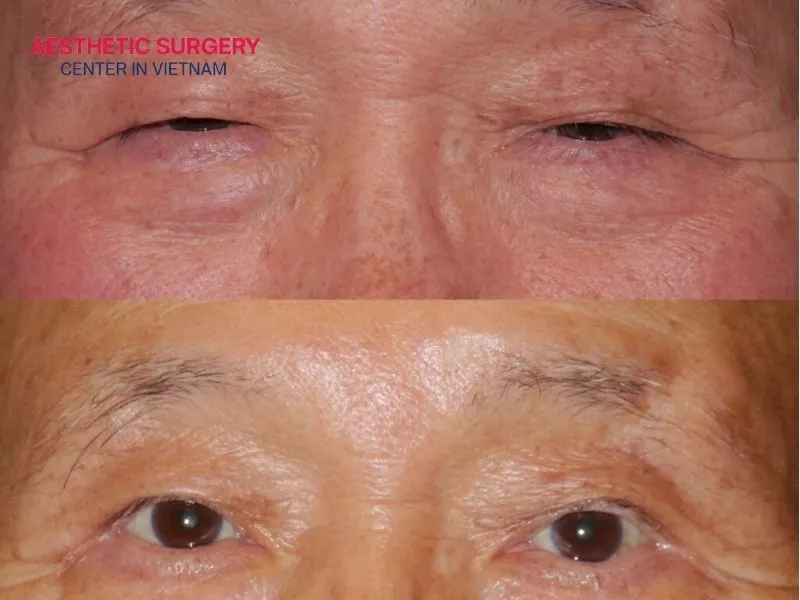 Individuals with moderate excess skin and good overall health can undergo laser blepharoplasty eyelid surgery.