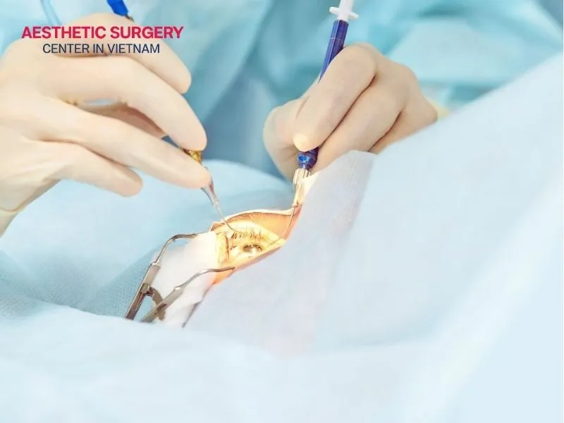 Laser blepharoplasty eyelid surgery procedure