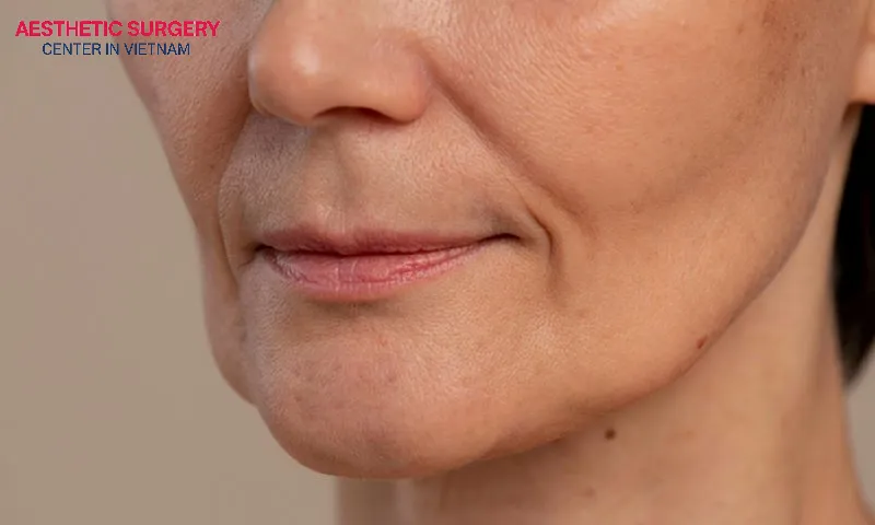 Repeated filler injections can lead to filler addiction