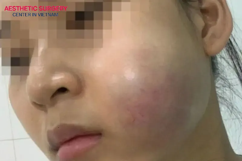 Filler migration can create small lumps that are not only unsightly but also affect health