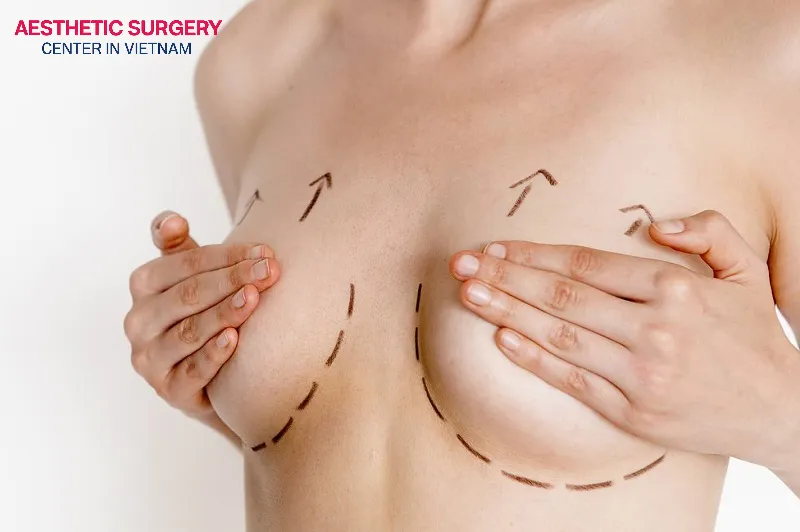 No scarring after breast augmentation