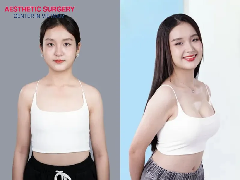 Nonsurgical breast augmentation is suitable for people in good health who are afraid of surgery and afraid of scarring