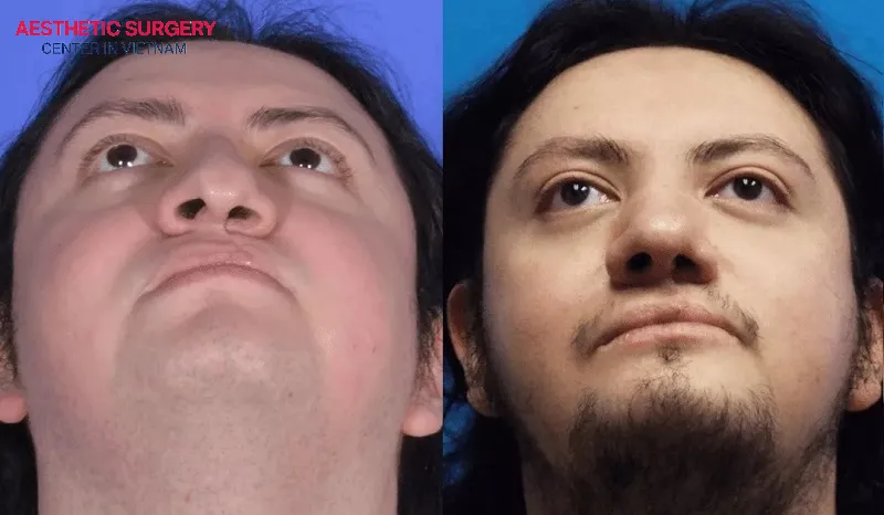 The young man’s face appears more youthful and harmonious after cleft palate rhinoplasty.