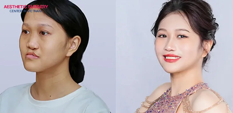 After rhinoplasty cleft palate, the young woman not only looks more attractive but also feels more confident about her appearance.