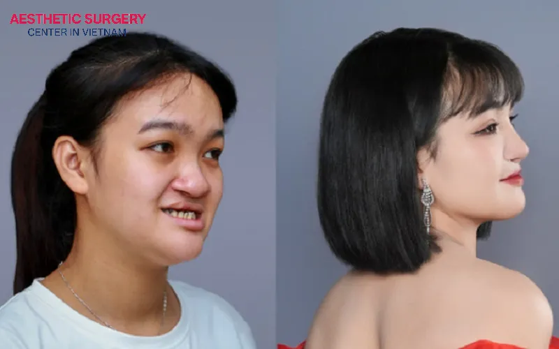 The young woman experiences a complete transformation in appearance after cleft palate rhinoplasty.