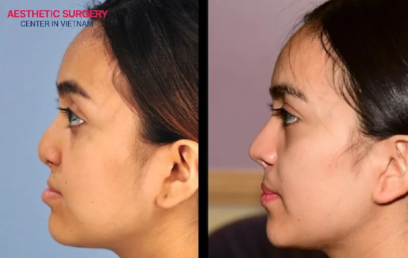 Cleft lip rhinoplasty, also known as cleft palate rhinoplasty, helps reconstruct the entire collapsed nasal base.