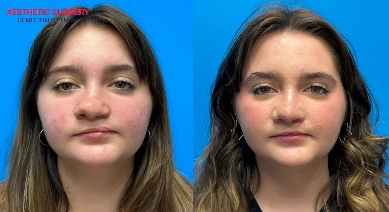 Rhinoplasty cleft palate helps create a more balanced and harmonious face, significantly enhancing overall facial aesthetics.