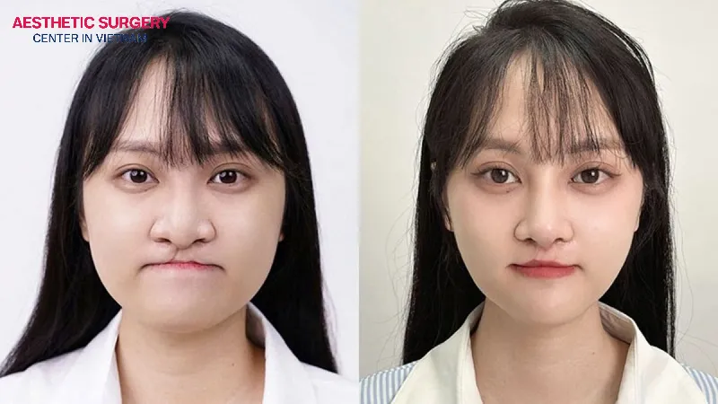 Cleft palate rhinoplasty helps many young patients regain confidence in their appearance, feel more comfortable in communication, and achieve greater success in their careers.