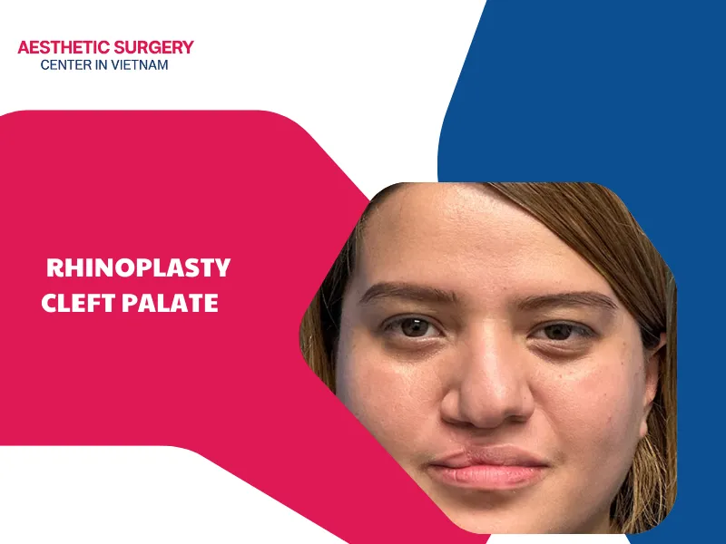 What is rhinoplasty cleft palate? Cleft palate rhinoplasty cost?