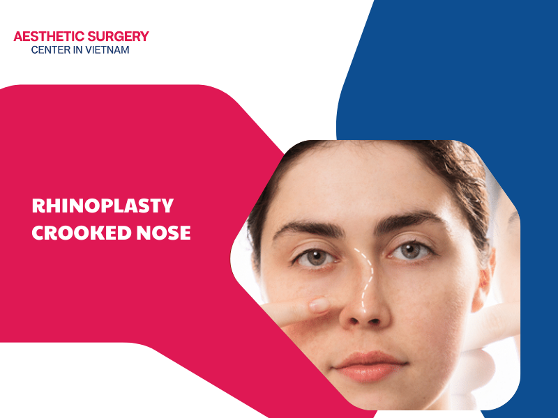 What is crooked nose rhinoplasty? Rhinoplasty crooked nose cost?