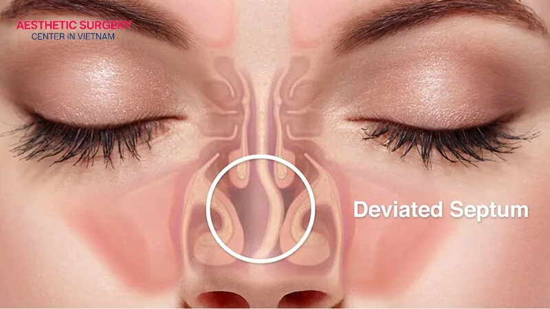 A deviated nasal septum affects both breathing function and nasal appearance.