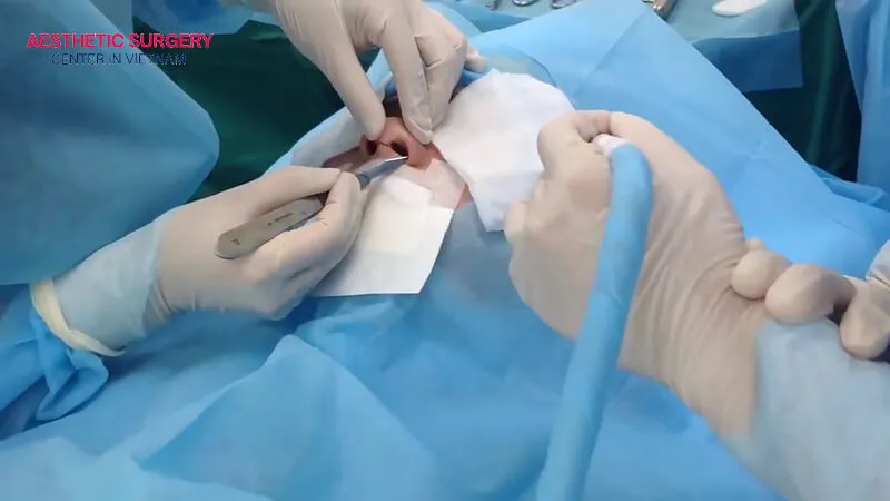 A small incision is made across the columella to access the nasal structure and perform precise correction.