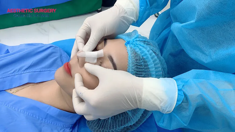 After the correction is completed, your nose will be stabilized to maintain its new shape.