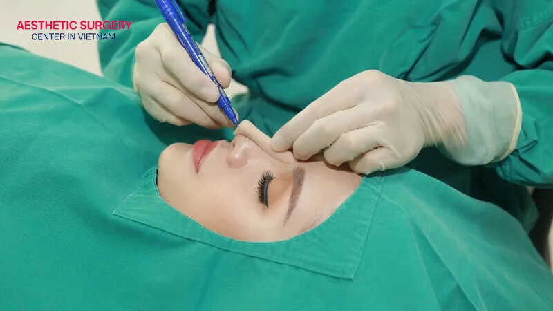 The cost of septo rhinoplasty in Vietnam is approximately USD 1,500 to 4,500.