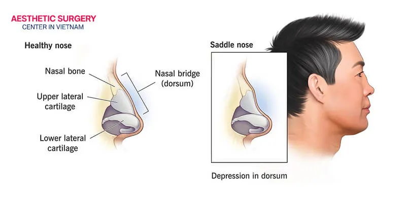 A saddle nose mainly results from damage to the nasal septum.