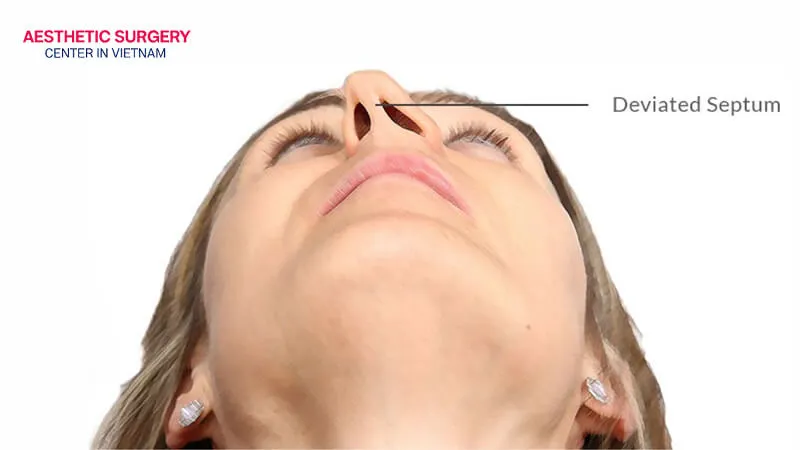 A deviated nasal septum causes the two nasal cavities to shift toward one side.