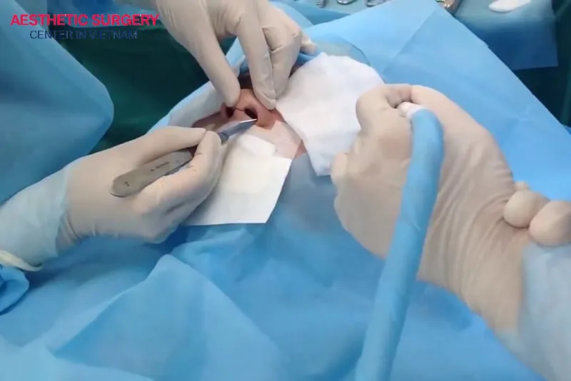 Excess septal cartilage and alar cartilage are removed to reduce the overall nasal length.