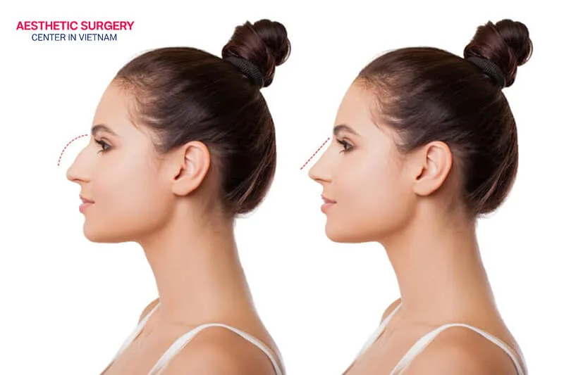 The nose is reshaped to be well-balanced and remains stable for many years after long nose rhinoplasty.