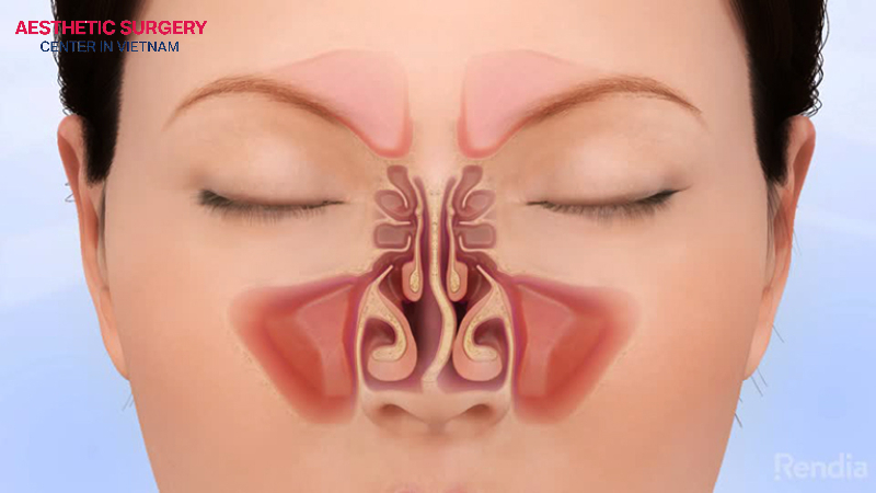 A crooked nose can be caused by trauma.