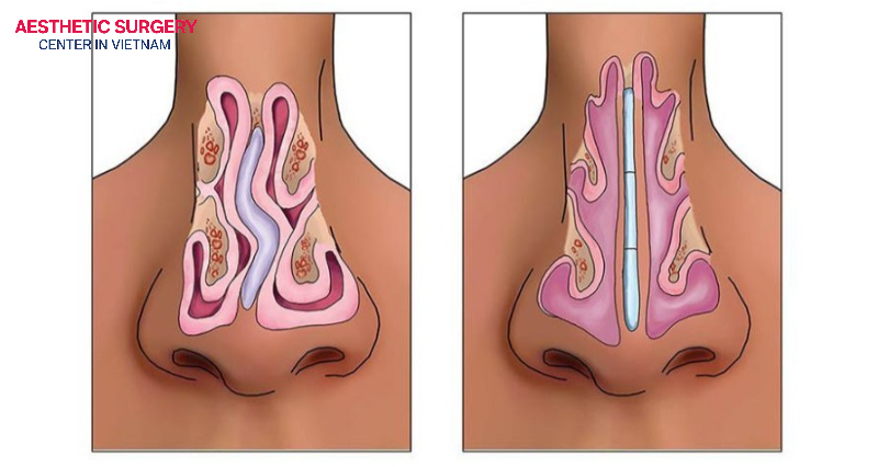 Septoplasty is an ideal solution for correcting a crooked nose.