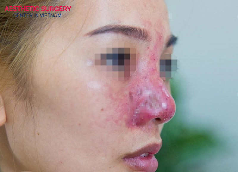 Nasal infection after crooked nose rhinoplasty may occur if sterile standards are not ensured or post-operative care is not performed properly.