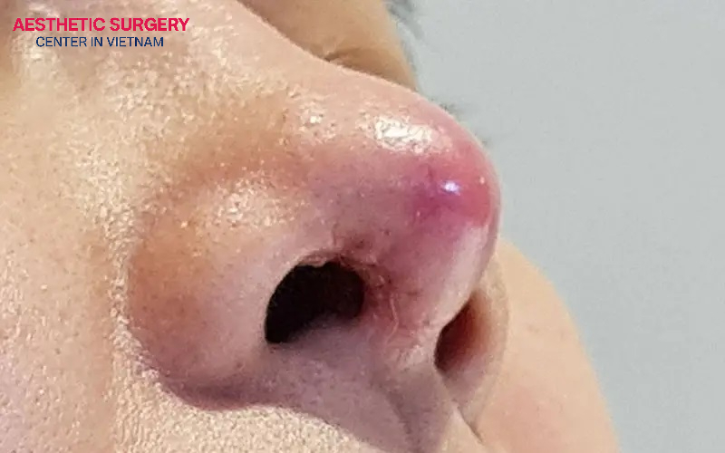 A reaction to implant material can cause a red nasal tip and increase the risk of implant visibility.