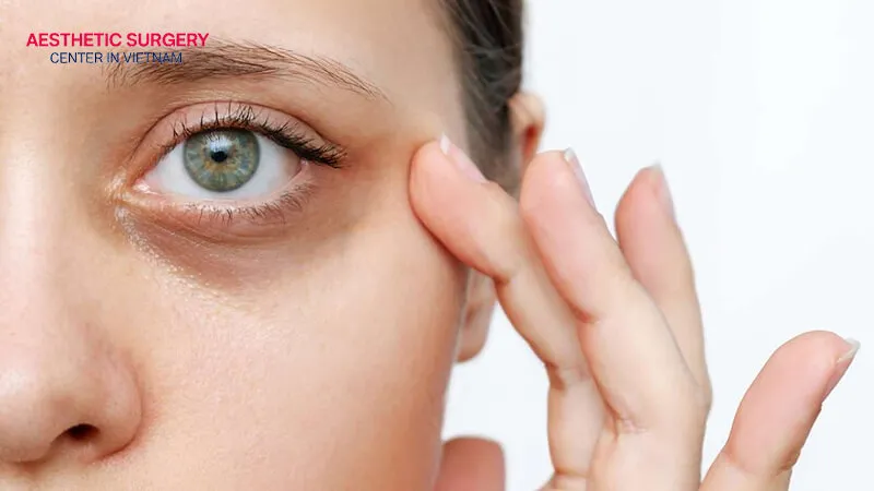 Individuals with hollow eyes or signs of aging in the eye area can choose upper eyelid fillers.