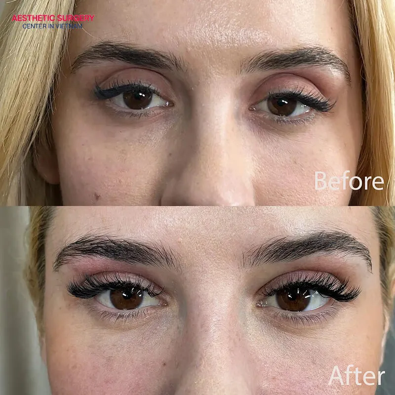 After two weeks, the filler injection area has fully recovered and achieves the best aesthetic result.