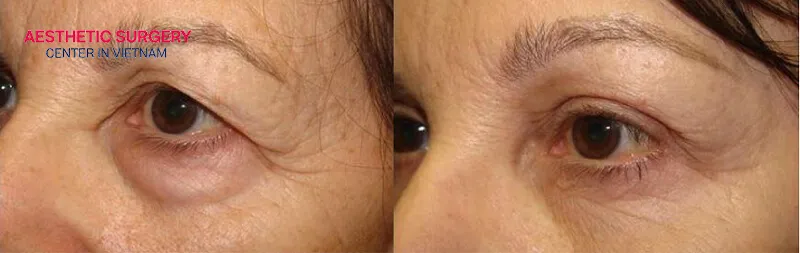 Significantly improves signs of eye aging.