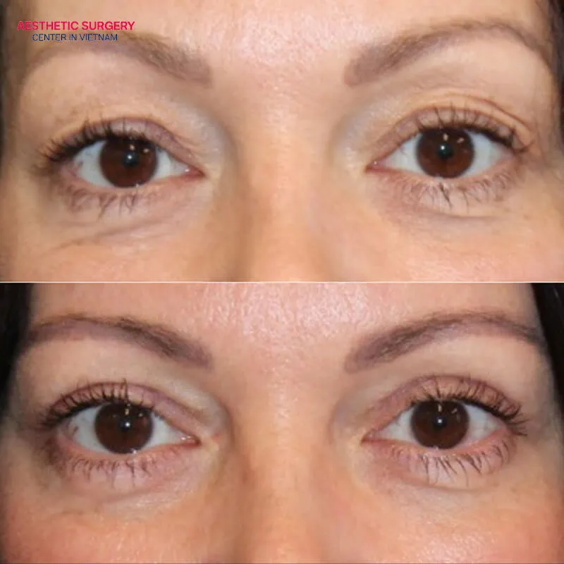 After upper eyelid fillers, you will look more refreshed and more vibrant.