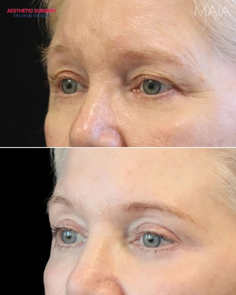 Say goodbye to an aged appearance with dermal filler upper eyelid.
