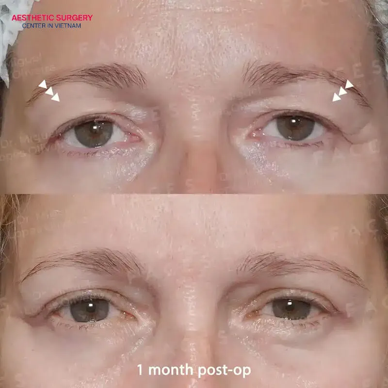 The results can be clearly seen after one month.