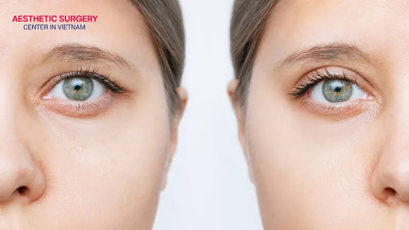 Upper eyelid fillers are safe when performed at a reputable clinic.