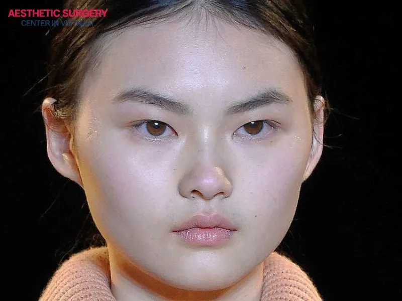 Monolid eyes are an eye shape commonly found in Asians, especially in East Asian countries such as Korea, Japan, and Vietnam.