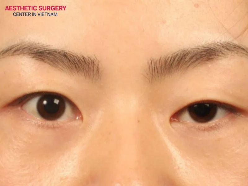 Other factors such as injuries, cosmetic complications, or lifestyle habits can also lead to monolid eyes.