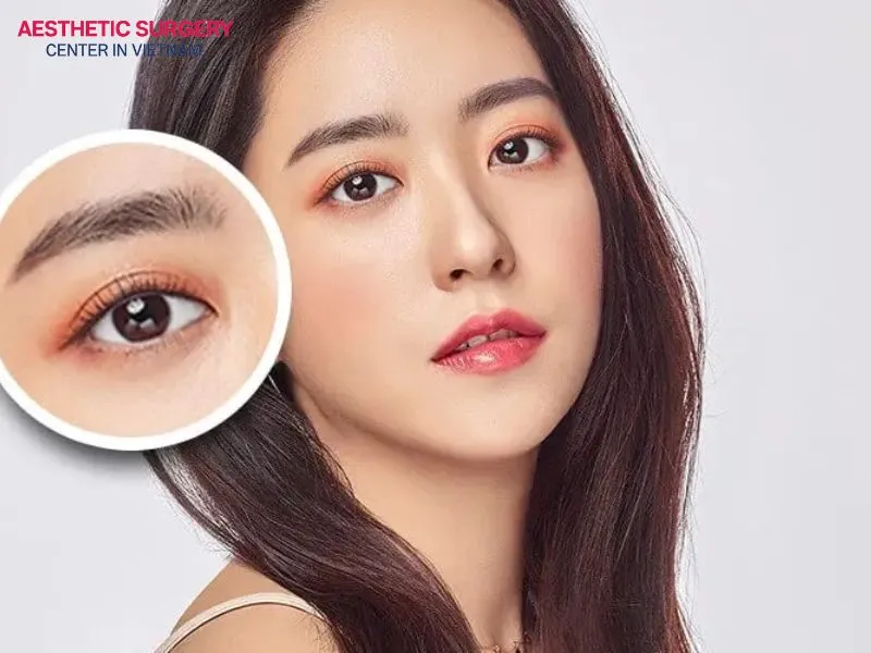 Eyelid stitching is a non-permanent solution that effectively improves monolid eyes, creating bigger and more attractive eyes.