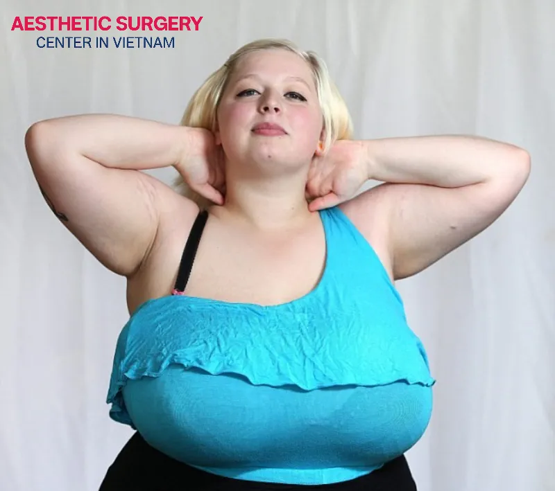 Symptoms of excessive breast size, such as back pain, neck pain, and shoulder pain, can be evidence used by insurance companies to determine eligibility for benefits