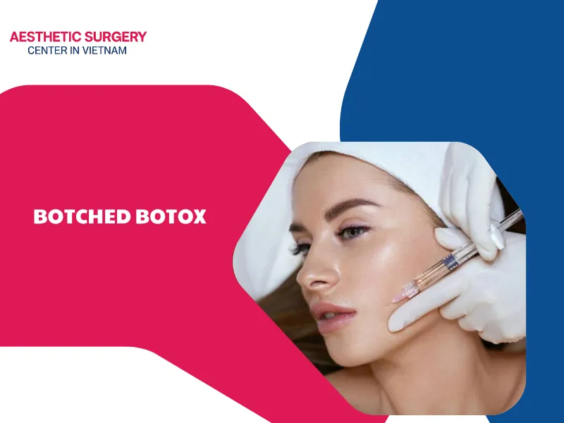 What are the causes of botched botox? How to prevent it?