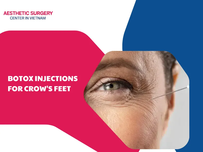 What are botox injections for crow's feet? Essential information