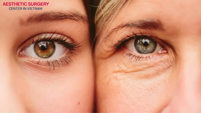 Wrinkles at the corners of the eyes usually appear due to both natural aging and environmental factors.