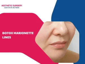 What are botox marionette lines? What you should know