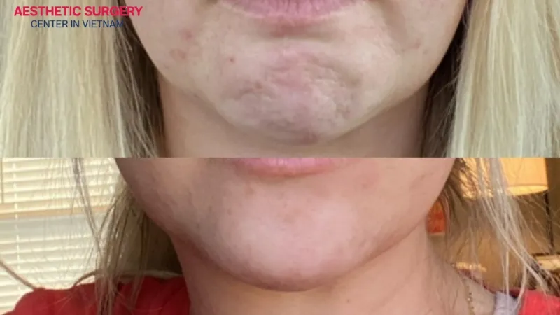 The chin becomes smooth after botox injection