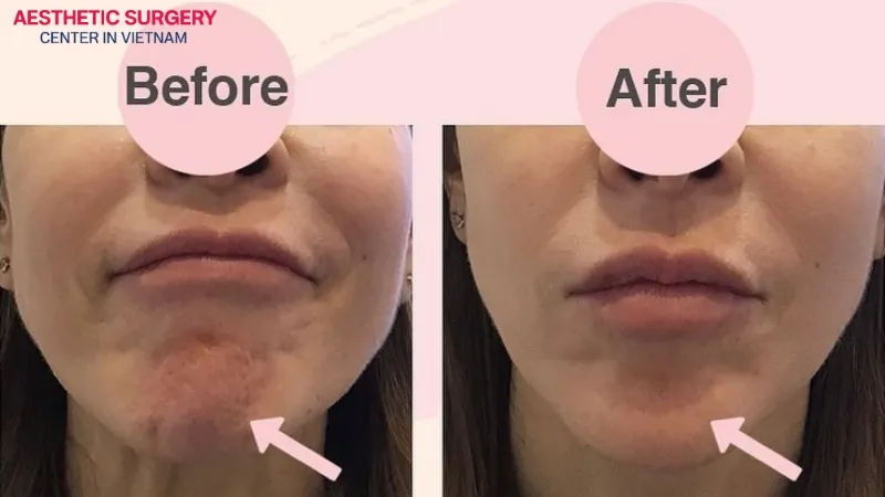 The chin becomes fuller and no longer wrinkled