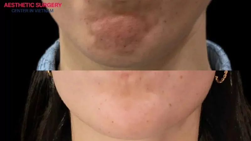 The chin becomes smooth after botox injection