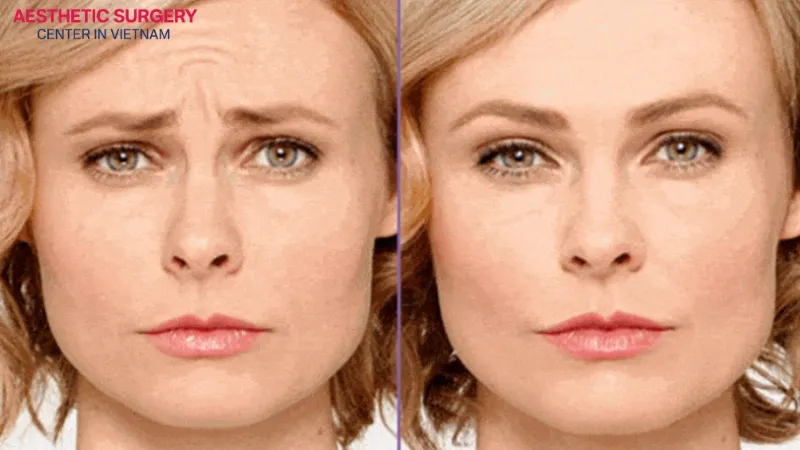 The benefit of a botox smile lift is improving a “sad-looking” face.